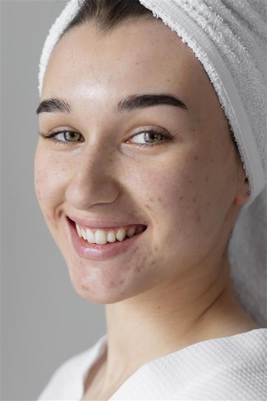 Acne Treatment