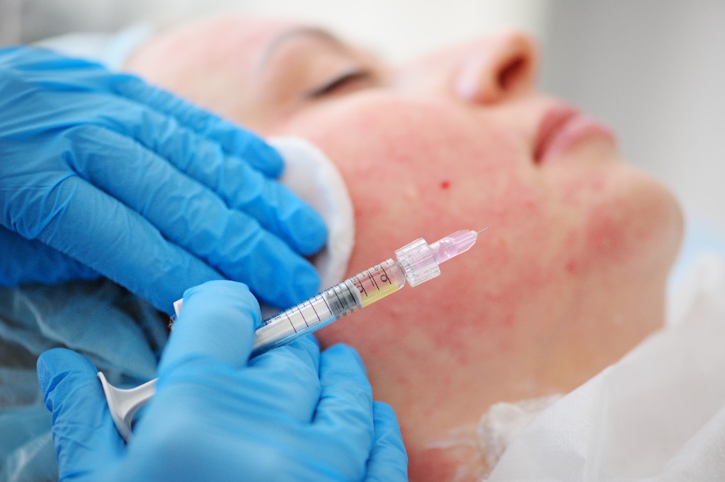 Acne Treatment