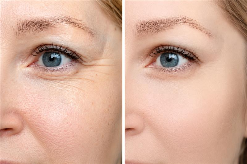 Botox Treatment before and after